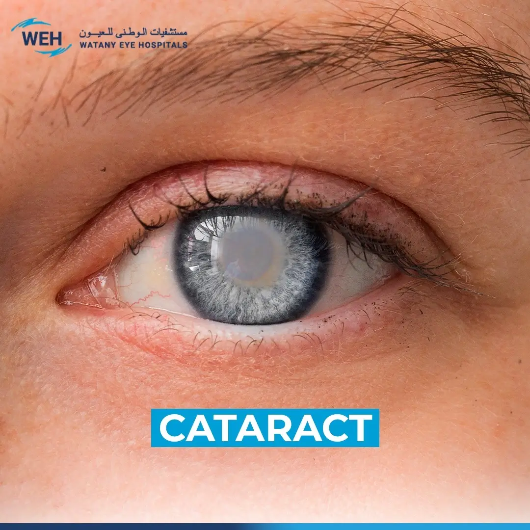 Cataracts - Symptoms and Treatment