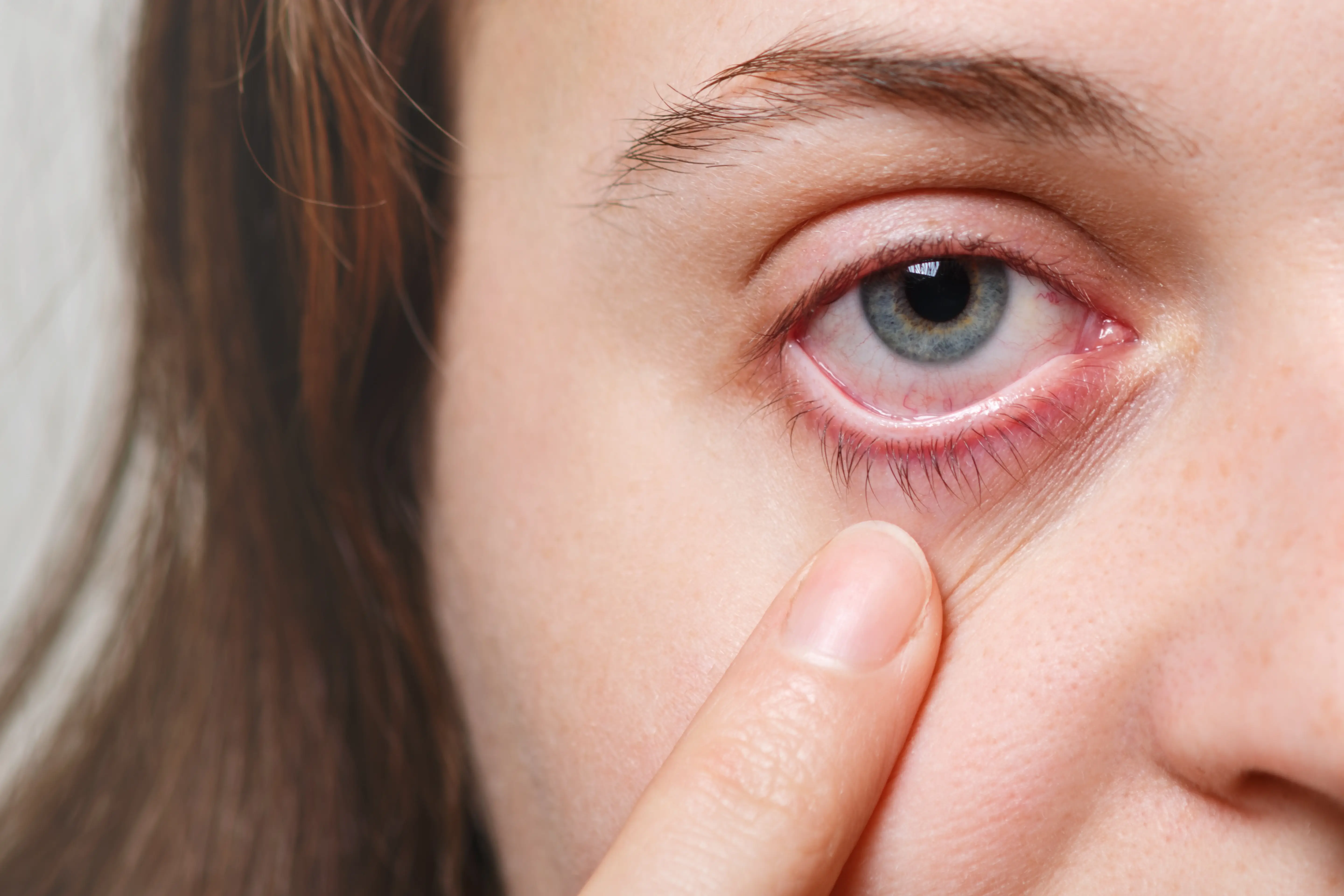 Dry Eye: Symptoms, Causes & Effective Treatments