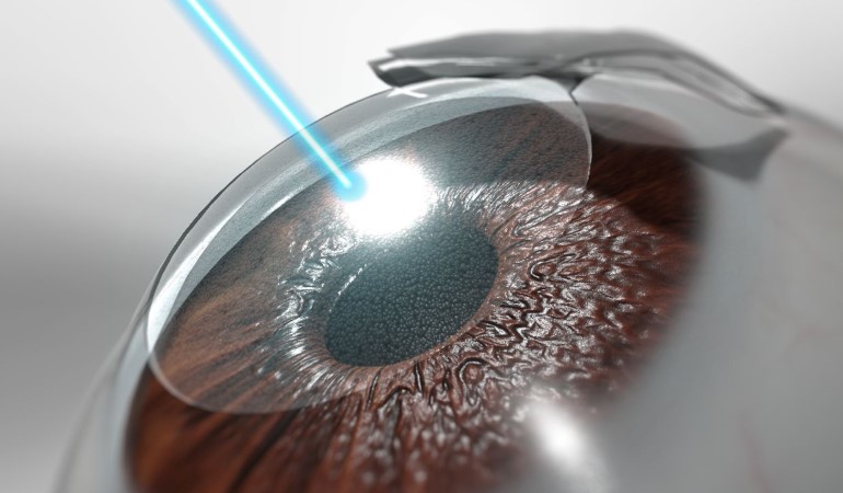 refractive Surgery