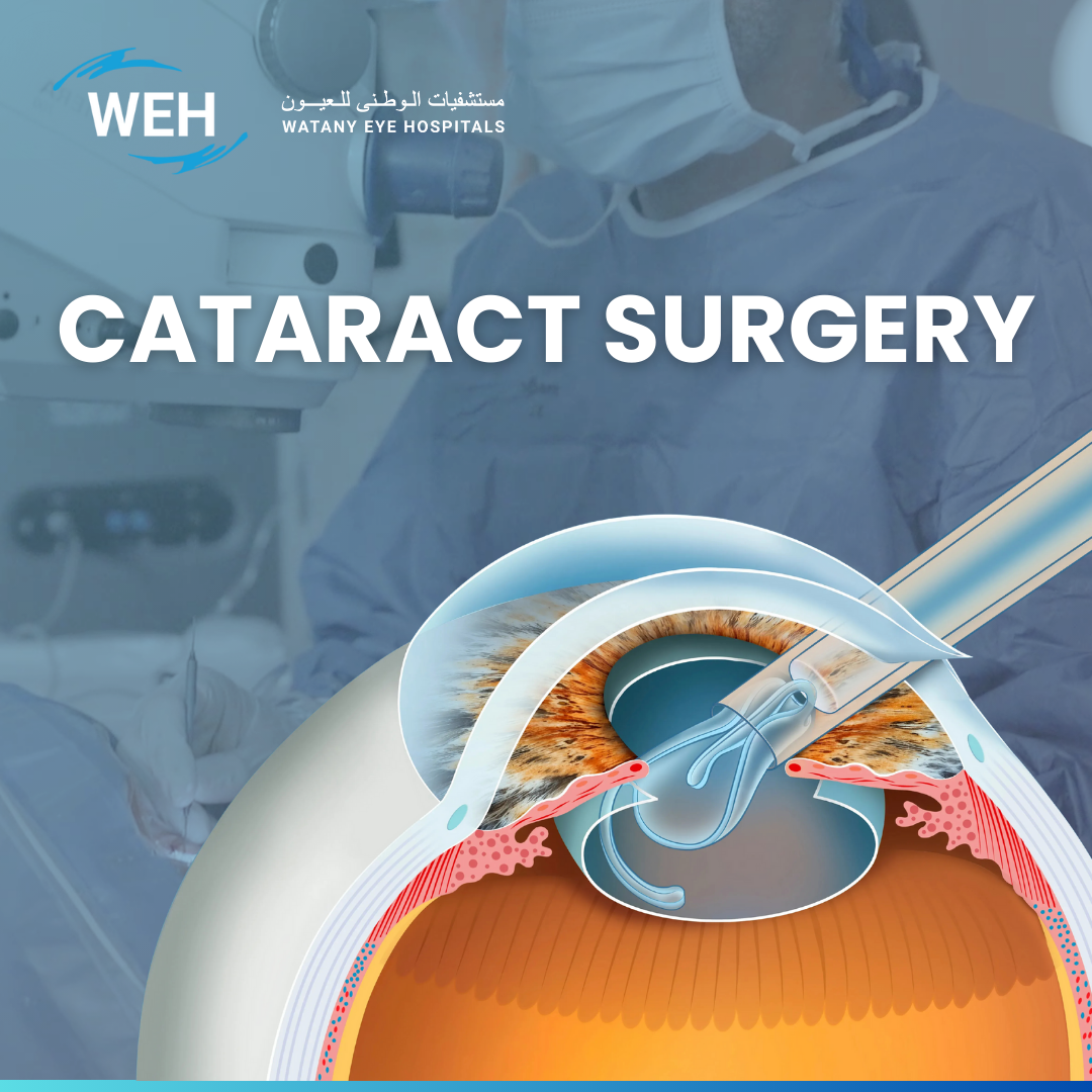 Cataract Surgery