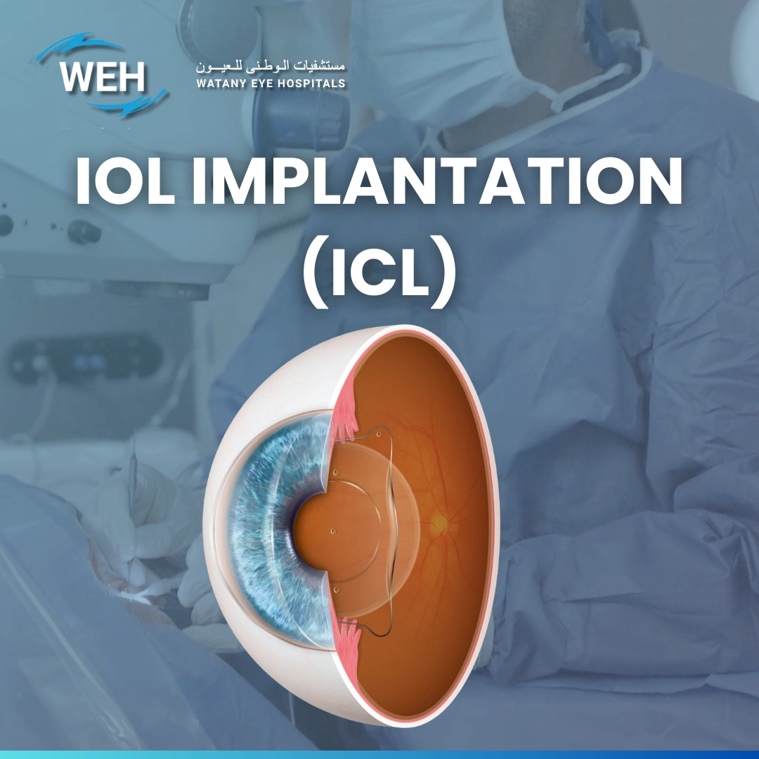 IOL Implantation (ICL)