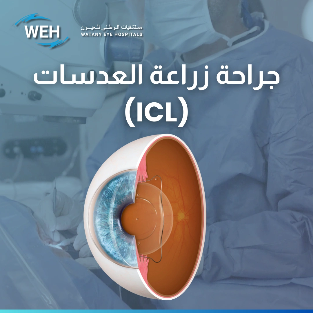 زراعة عدسة ICL داخل العين
